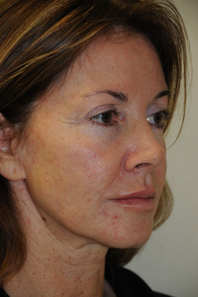 Facelift Patient 01 Before