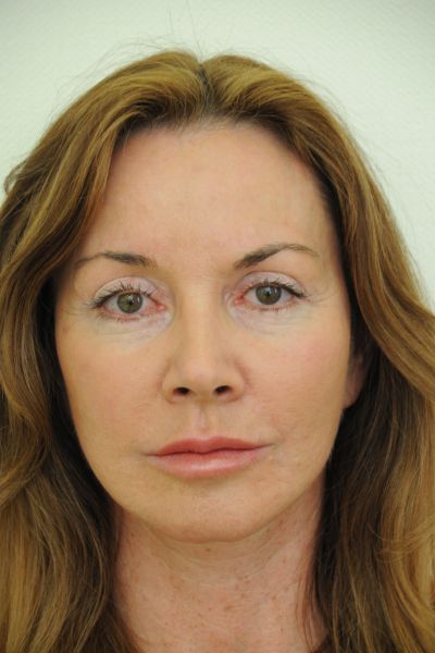 Facelift Patient 01 After - 2