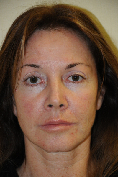 Facelift Patient 01 Before - 2