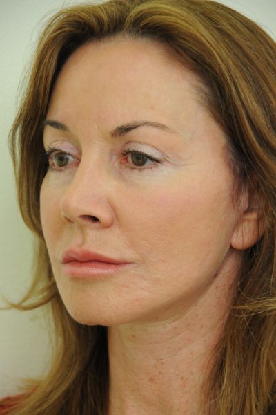 Facelift Patient 01 After - 3