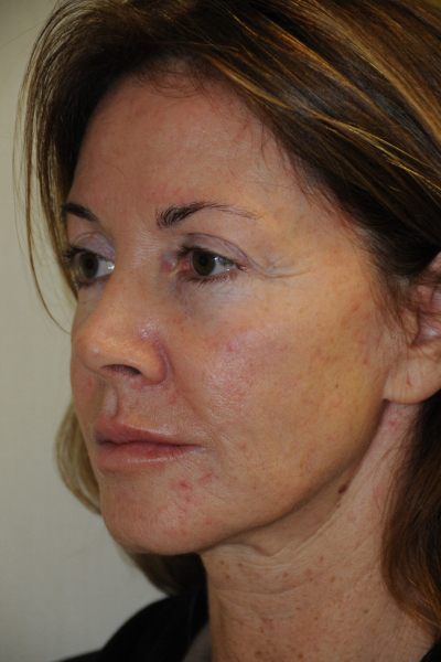 Facelift Patient 01 Before - 3