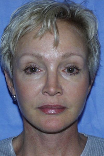 Facelift Patient 02 After