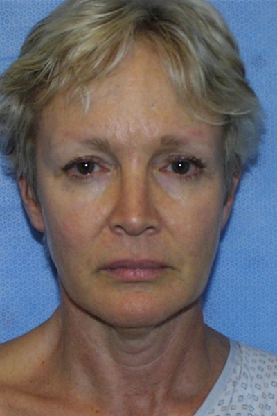 Facelift Patient 02 Before