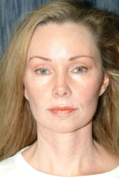 Facelift Patient 03 After