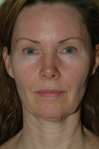 Facelift Patient 03 Before