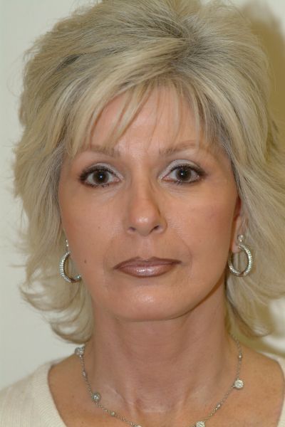 Facelift Patient 04 After