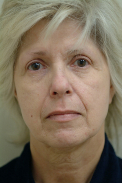 Facelift Patient 04 Before