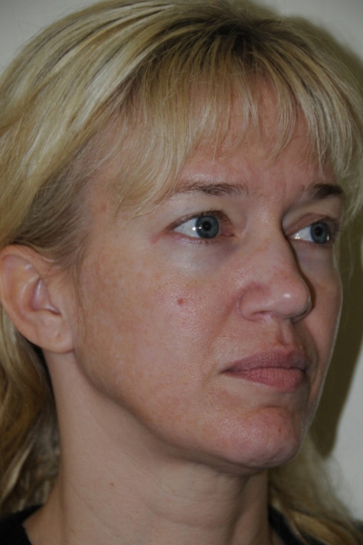 Facelift Patient 05 Before - 2