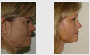 Vertical Facelift Before and After Photo
