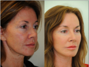 Stemcell Facelift Before and After