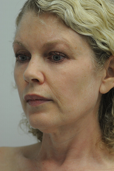 Facelift Patient 06 Before - 5