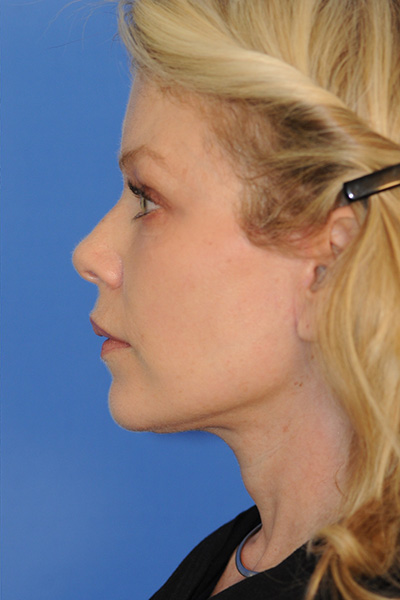 Facelift Patient 06 After - 4