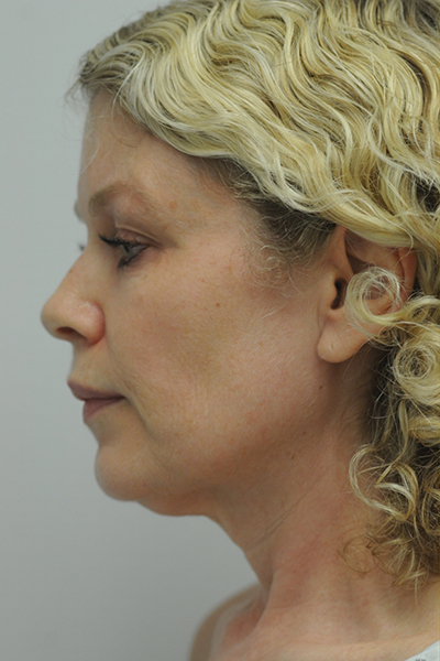 Facelift Patient 06 Before - 4