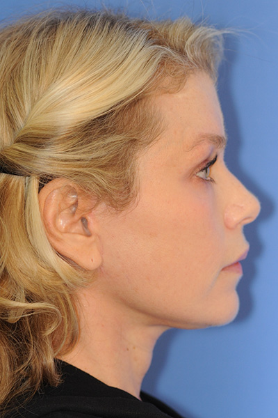 Facelift Patient 06 After - 3