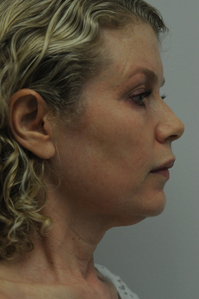 Facelift Patient 06 Before - 3