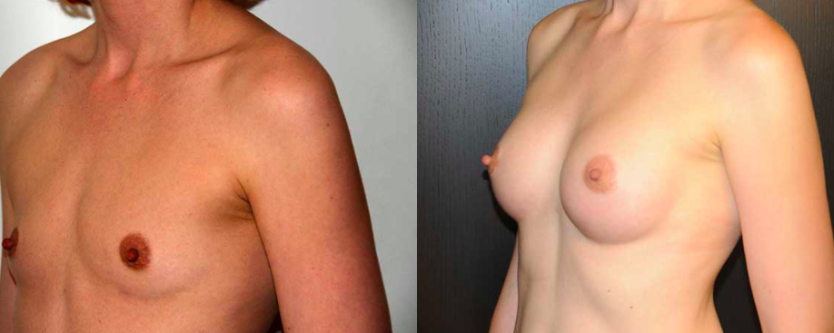 Dr. Calabria Stem Cell Breast Augmentation Patient