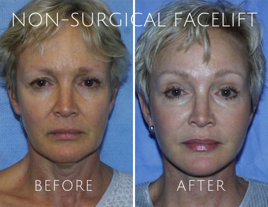 Non Surgical Facelift Before and After