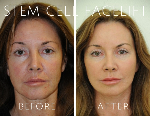 Stem Cell Facelift Before and After