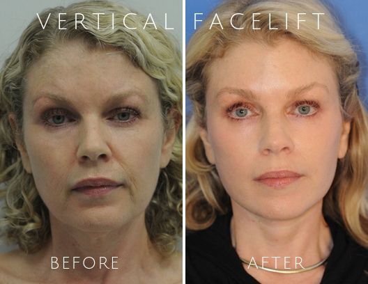 Verticle-Facelift-P1-Front.Verticle-Facelift-P1-Front-2-blog-ba-img (1)