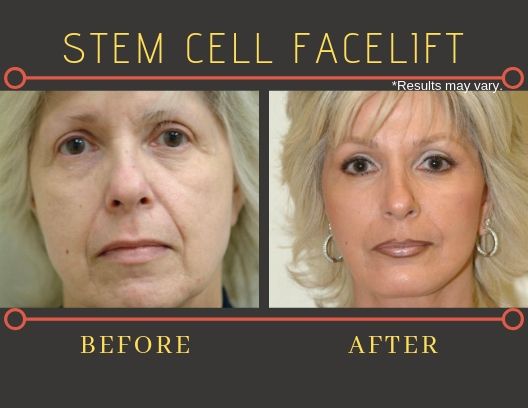 Before and after image showing results of a female patient's stem cell facelift surgery.