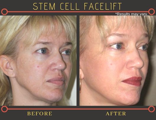 Before and after photos of a female patient who underwent vertical facelift surgery in Beverly Hills, CA.