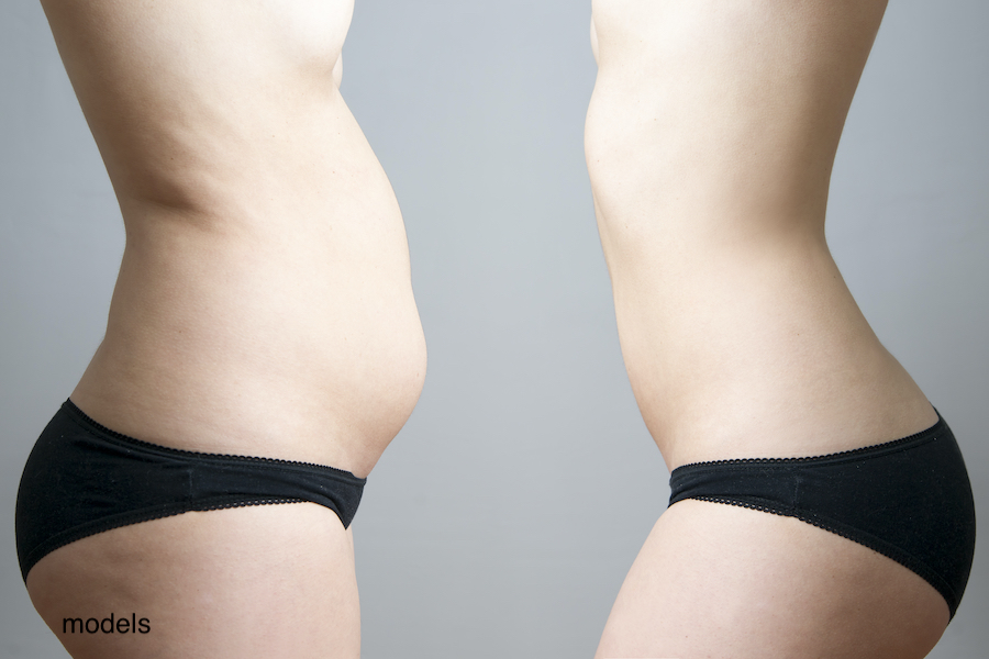 Belly fat is stubborn. Even after diet and exercise, many women need to turn to body contouring procedures like a tummy tuck or liposuction to get rid of it.